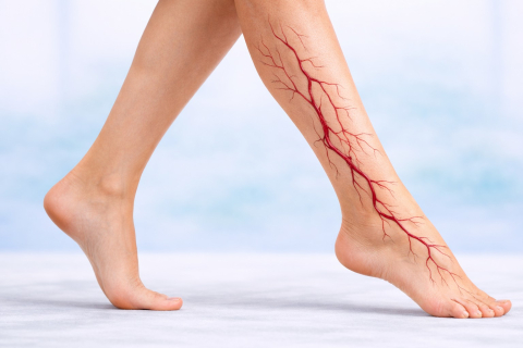 Тромбоз глубоких вен - как распознать опасное состояние